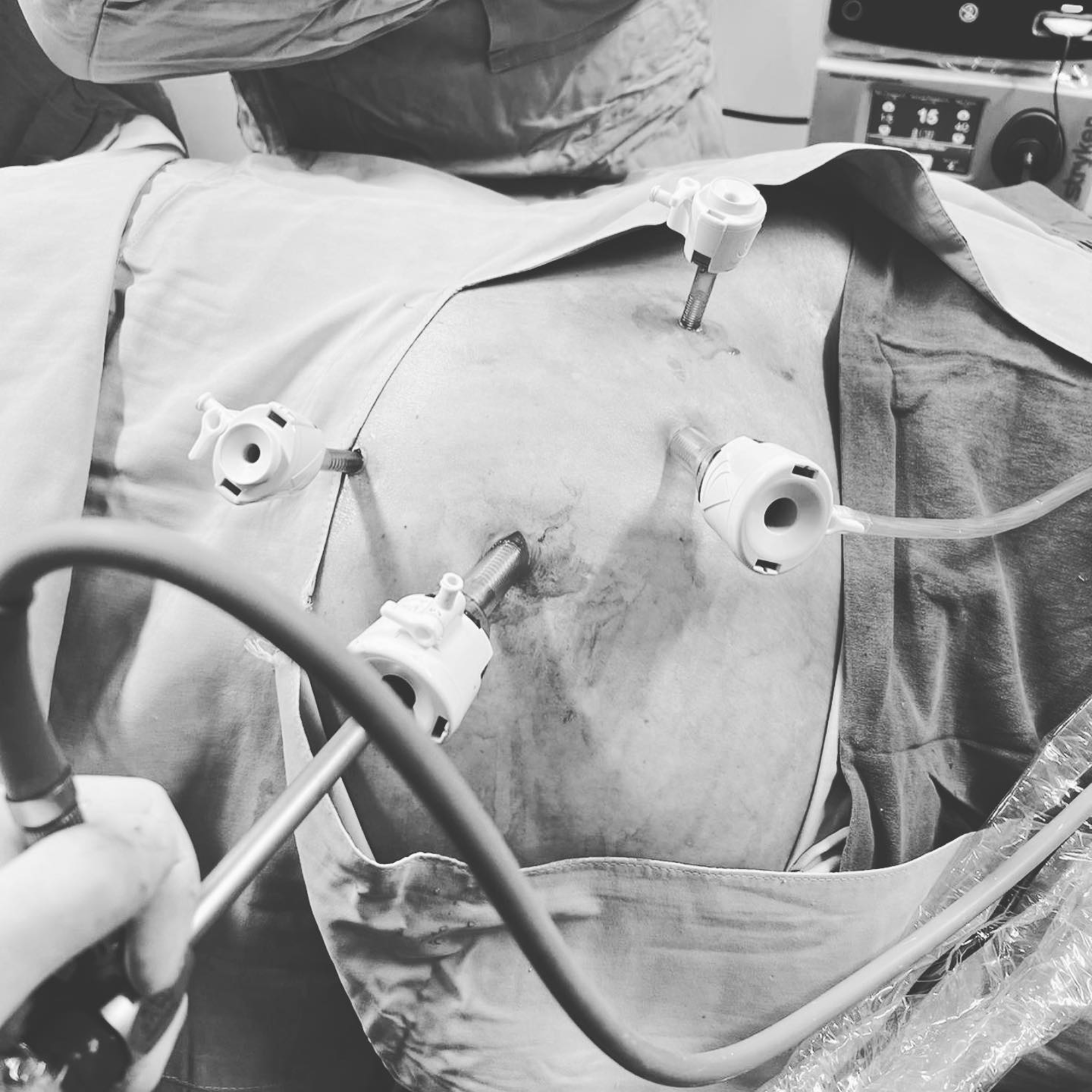 Procedimiento Láser