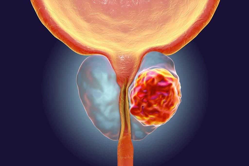 Consultorio urológico del Dr. Christian Morales - Detección y tratamiento de cáncer de próstata en Mazatlán