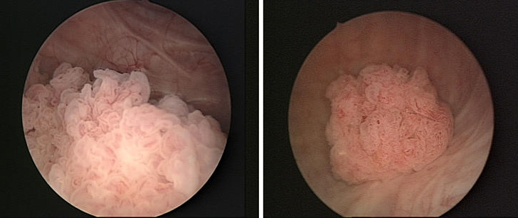 Diagnóstico y detección temprana de cáncer de vejiga