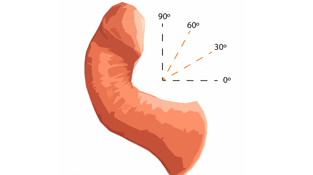 Consulta urológica para enfermedad de Peyronie - curvatura del pene