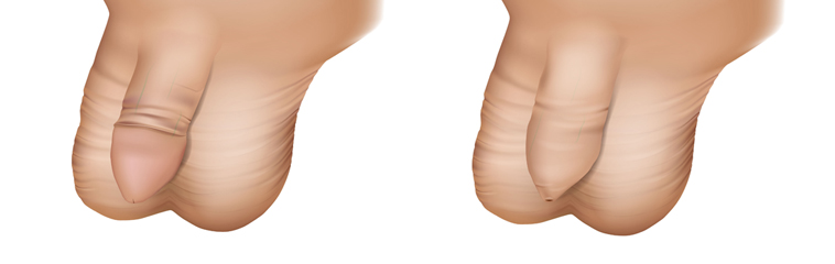 Tratamiento de fimosis con circuncisión láser en Mazatlán