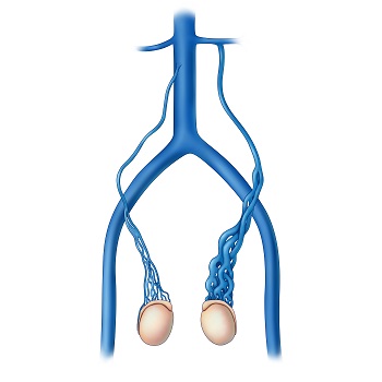 Diagnóstico y cirugía de varicocele en Mazatlán