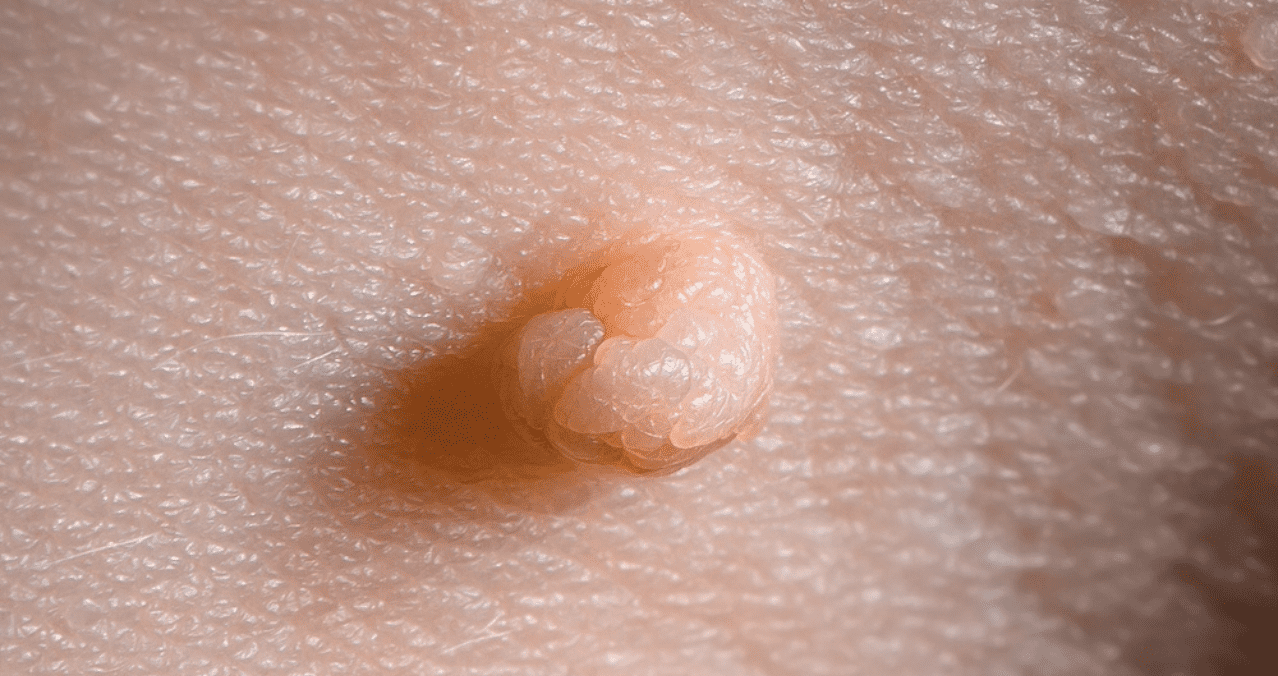 Diagnóstico y tratamiento de VPH y verrugas genitales en hombres